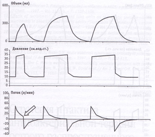 Графическое отображение параметров вентиляции у больного c ARDS